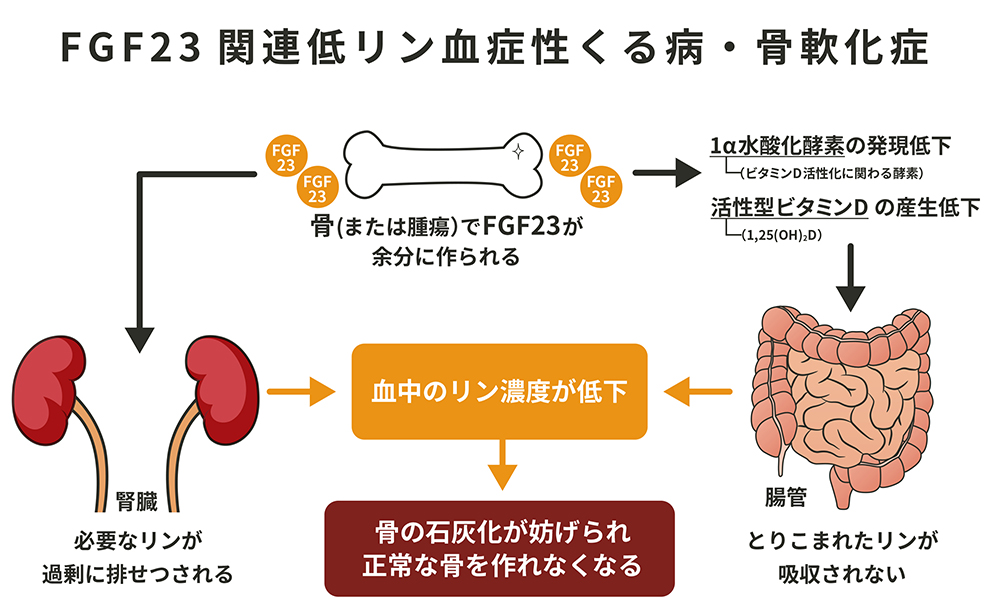 FGF23関連低リン血症性くる病・骨軟化症とは