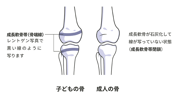 くる病・骨軟化症とは