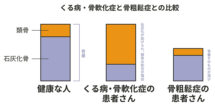 くる病・骨軟化症とは