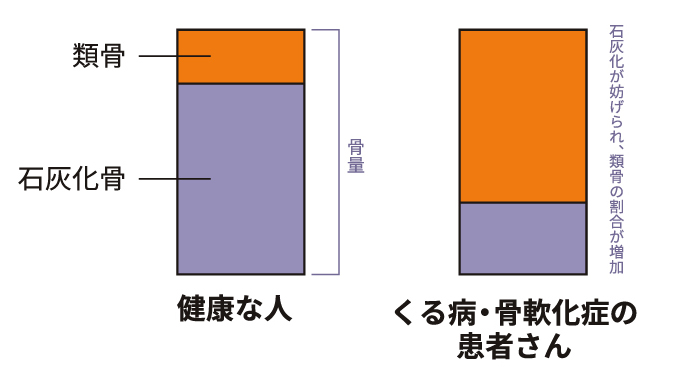 骨の痛みを伴う「くる病・骨軟化症」とは？