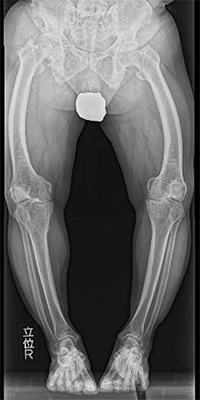 骨軟化症の症状