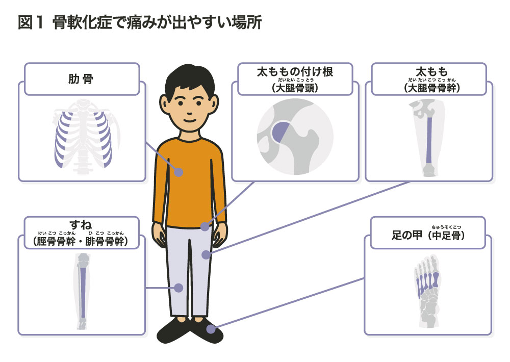 図1 骨軟化症で痛みが出やすい場所