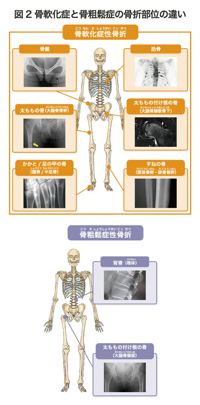 図2 骨軟化症と骨粗鬆症の骨折部位の違い