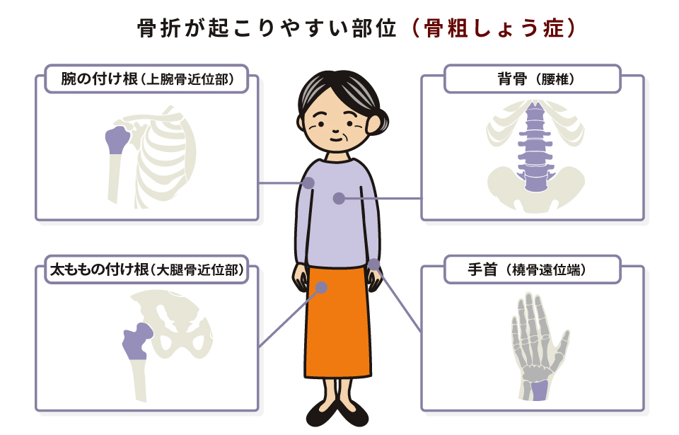 骨折が起こりやすい部位（骨粗しょう症）