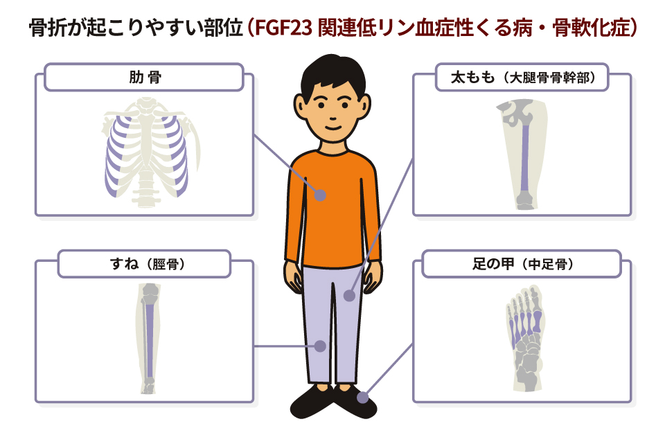 骨折が起こりやすい部位（くる病・骨軟化症）