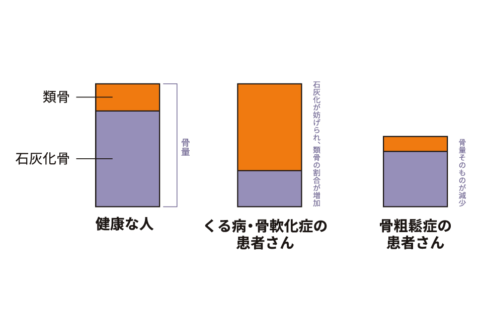 骨粗しょう症との違い