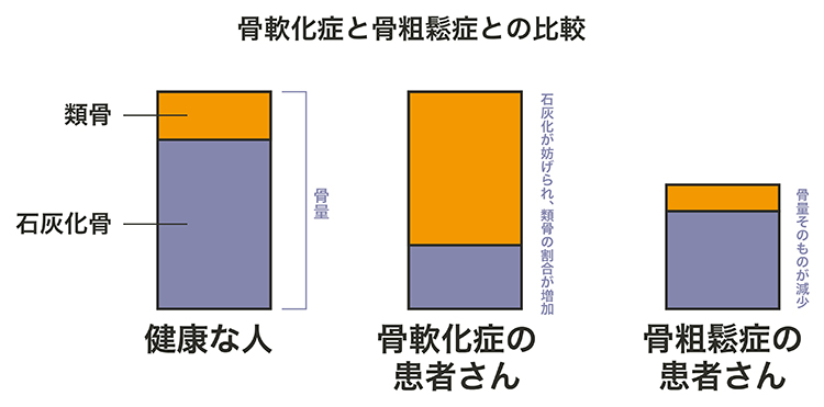 骨軟化症と骨粗鬆症の違い②骨の質・量の違い